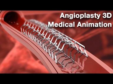 Angioplasty - Medical animation cover